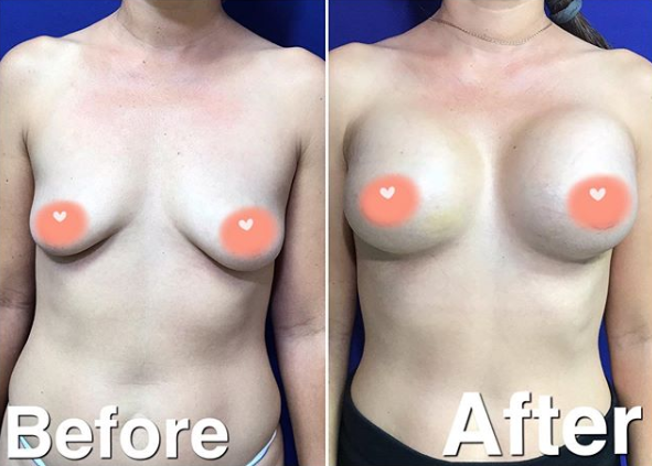breast augmentation before after miami